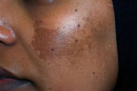 dark spots on skin during pregnancy